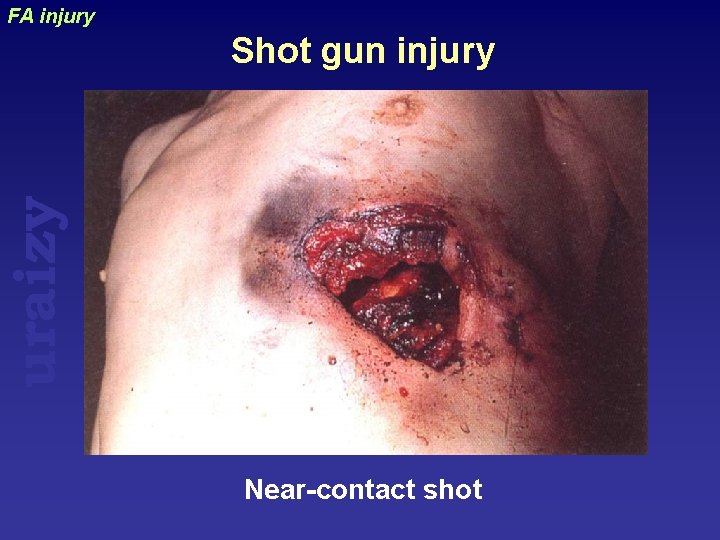 FA injury uraizy Shot gun injury Near-contact shot 