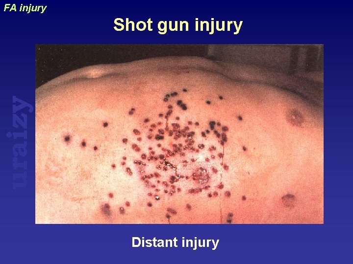 FA injury uraizy Shot gun injury Distant injury 