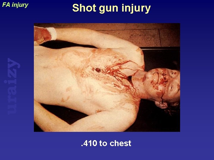 Shot gun injury uraizy FA injury . 410 to chest 