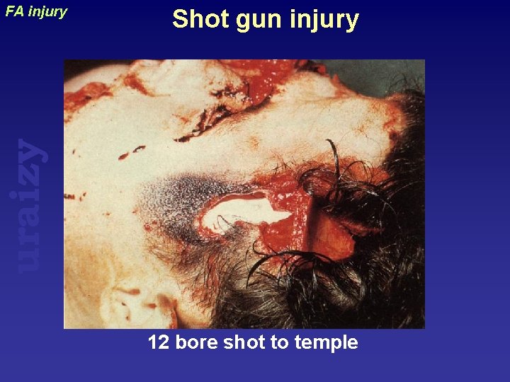Shot gun injury uraizy FA injury 12 bore shot to temple 