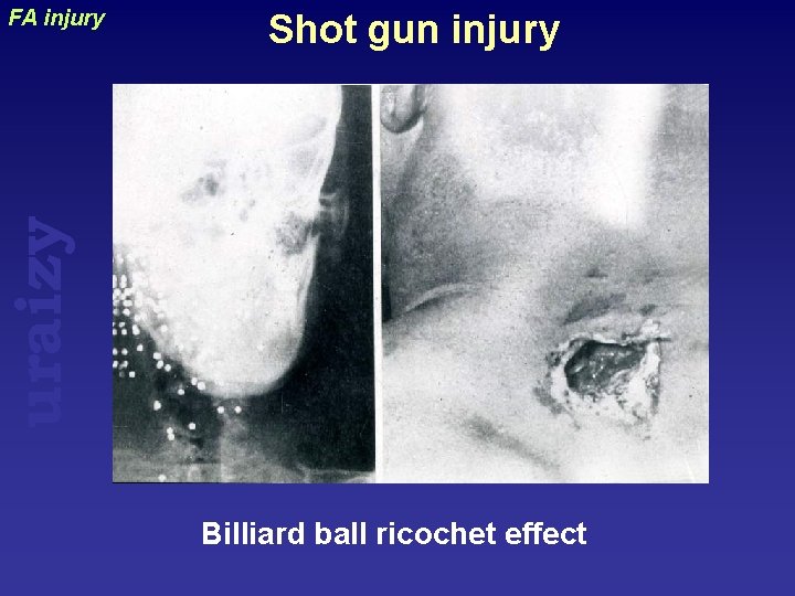 Shot gun injury uraizy FA injury Billiard ball ricochet effect 
