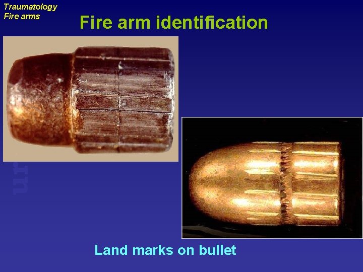 Fire arm identification uraizy Traumatology Fire arms Land marks on bullet 