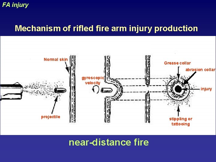 FA injury uraizy Mechanism of rifled fire arm injury production Normal skin Grease collar