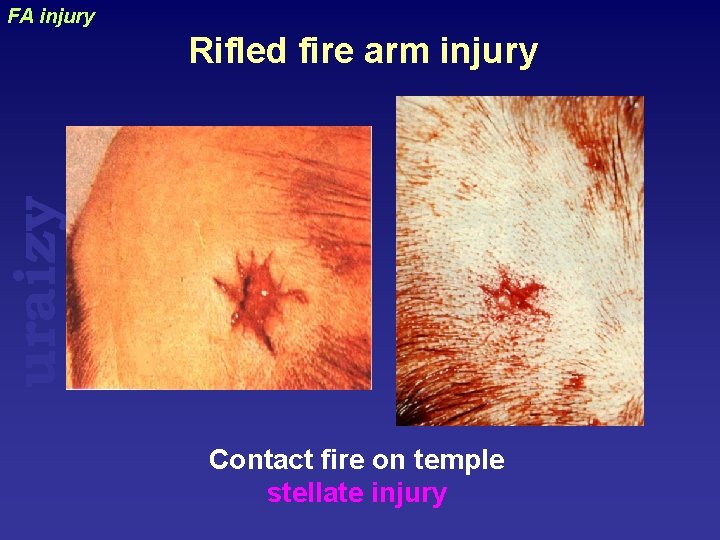 FA injury uraizy Rifled fire arm injury Contact fire on temple stellate injury 