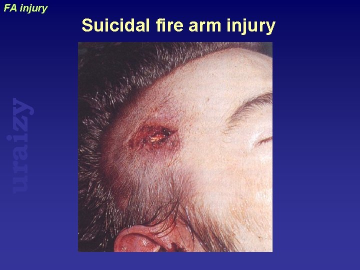 uraizy FA injury Suicidal fire arm injury 