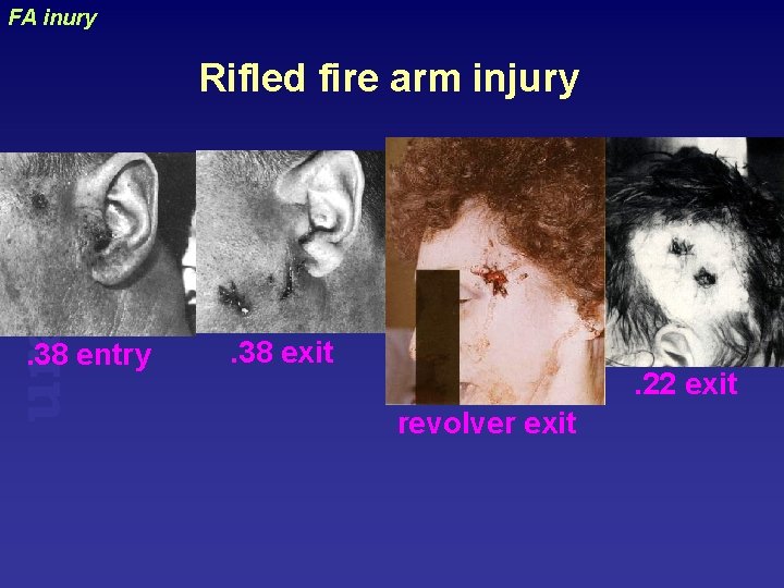 FA inury uraizy Rifled fire arm injury . 38 entry . 38 exit .