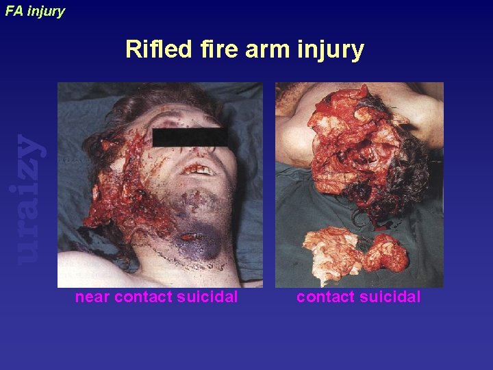 FA injury uraizy Rifled fire arm injury near contact suicidal 