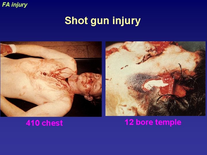 FA injury uraizy Shot gun injury 410 chest 12 bore temple 