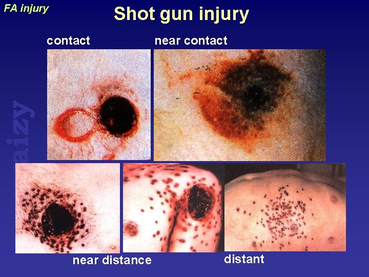 FA injury Shot gun injury near contact uraizy contact near distance distant 