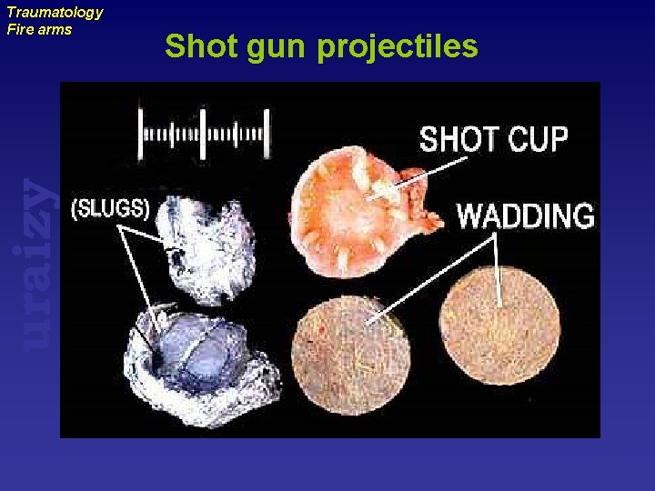 uraizy Traumatology Fire arms Shot gun projectiles 