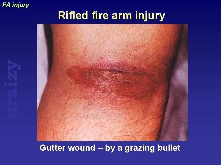 FA injury uraizy Rifled fire arm injury Gutter wound – by a grazing bullet