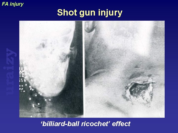 FA injury uraizy Shot gun injury ‘billiard-ball ricochet’ effect 