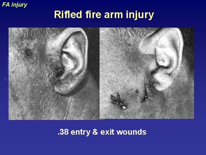 FA injury uraizy Rifled fire arm injury . 38 entry & exit wounds 