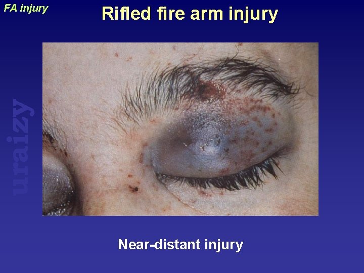 Rifled fire arm injury uraizy FA injury Near-distant injury 