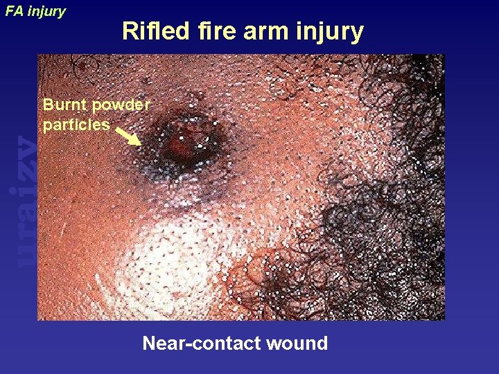 FA injury Rifled fire arm injury uraizy Burnt powder particles Near-contact wound 
