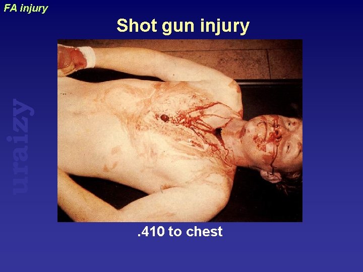 FA injury uraizy Shot gun injury . 410 to chest 