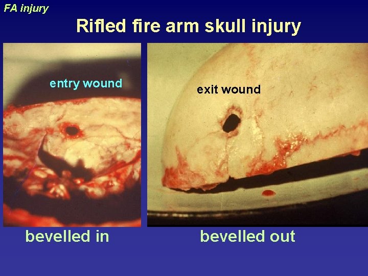 FA injury Rifled fire arm skull injury exit wound uraizy entry wound bevelled in