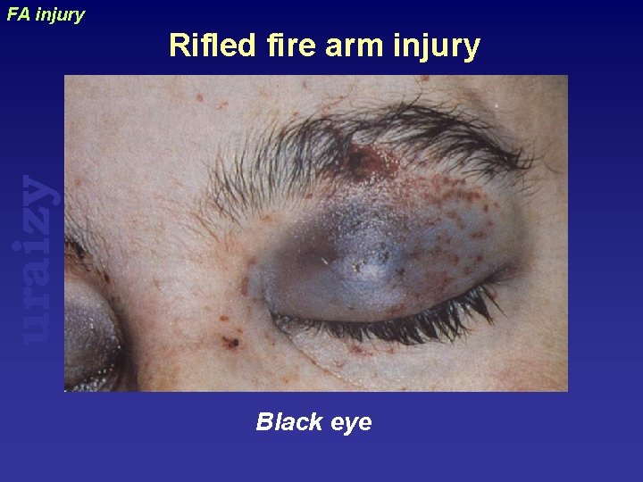 FA injury uraizy Rifled fire arm injury Black eye 