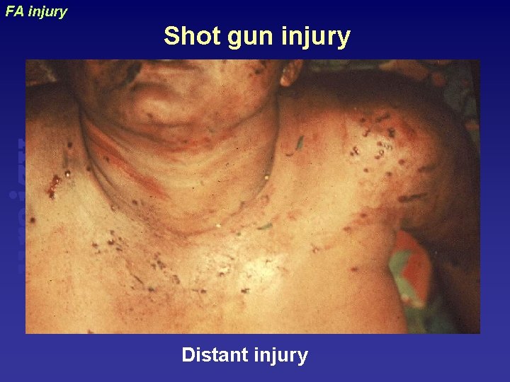 FA injury uraizy Shot gun injury Distant injury 