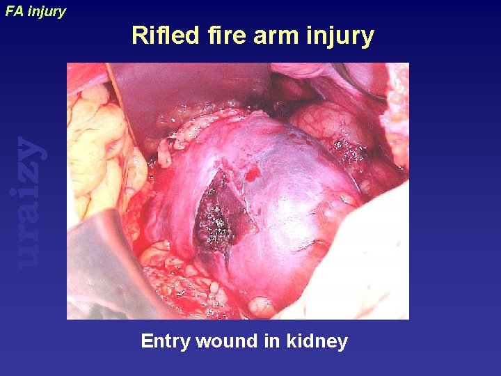FA injury uraizy Rifled fire arm injury Entry wound in kidney 