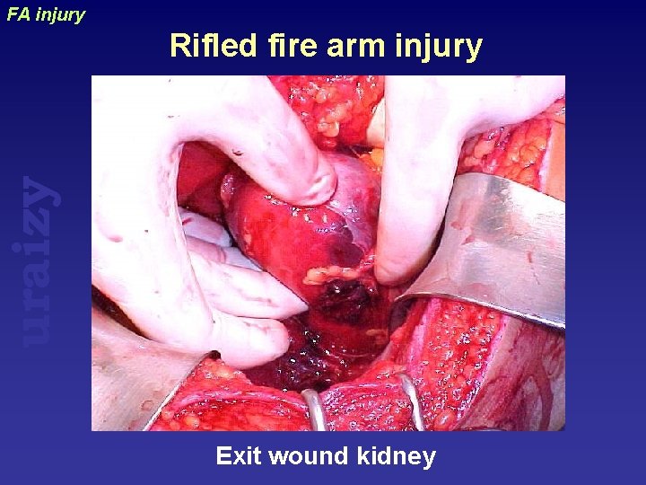 FA injury uraizy Rifled fire arm injury Exit wound kidney 