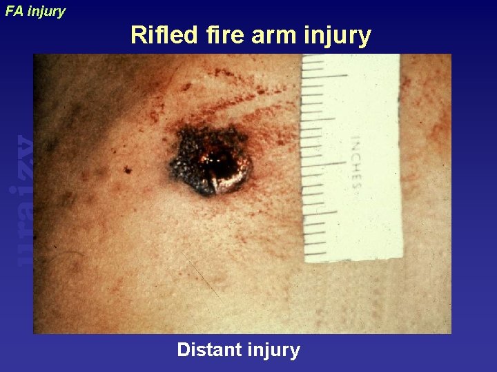 FA injury uraizy Rifled fire arm injury Distant injury 