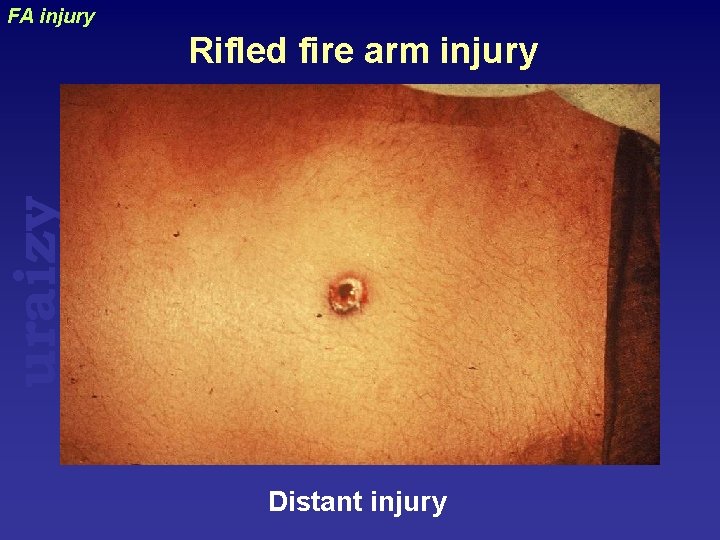 FA injury uraizy Rifled fire arm injury Distant injury 