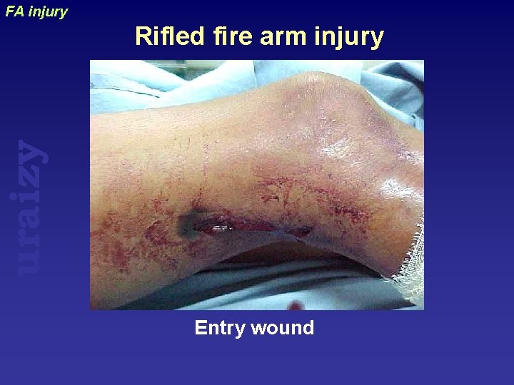 FA injury uraizy Rifled fire arm injury Entry wound 