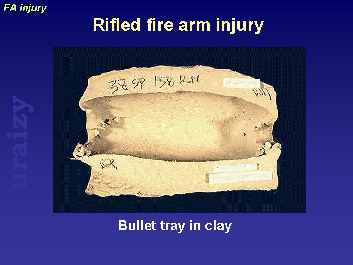 FA injury uraizy Rifled fire arm injury Bullet tray in clay 