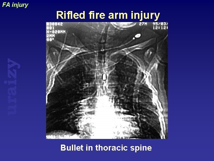 FA injury uraizy Rifled fire arm injury Bullet in thoracic spine 