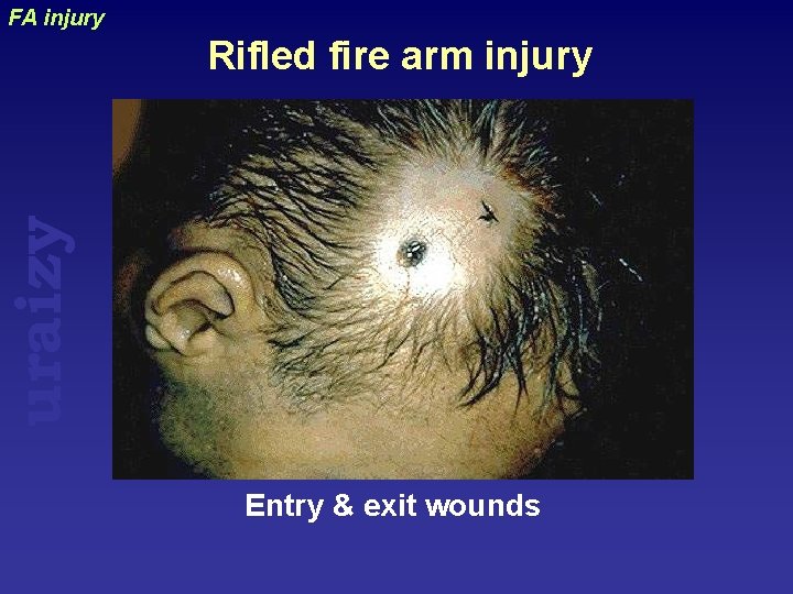 FA injury uraizy Rifled fire arm injury Entry & exit wounds 