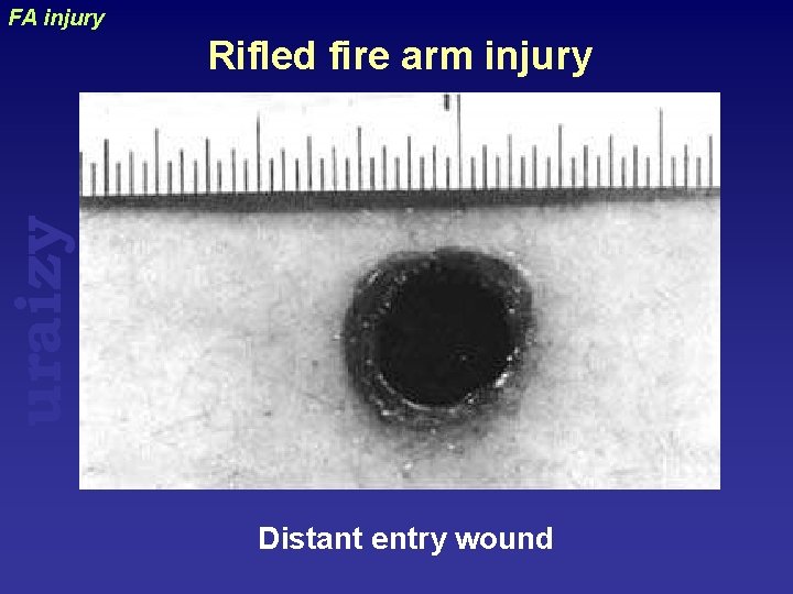 FA injury uraizy Rifled fire arm injury Distant entry wound 