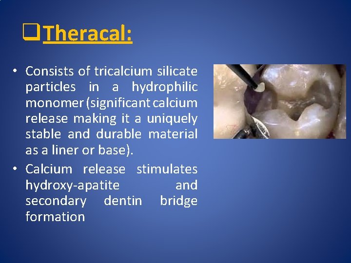 q Theracal: • Consists of tricalcium silicate particles in a hydrophilic monomer (significant calcium