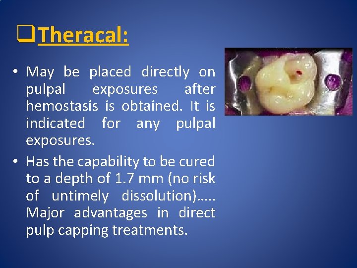 q Theracal: • May be placed directly on pulpal exposures after hemostasis is obtained.