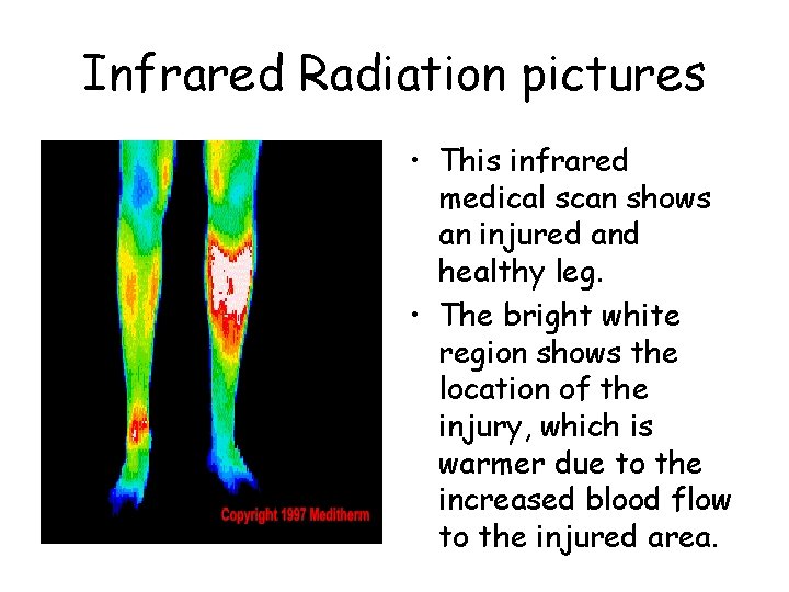 Infrared Radiation pictures • This infrared medical scan shows an injured and healthy leg.