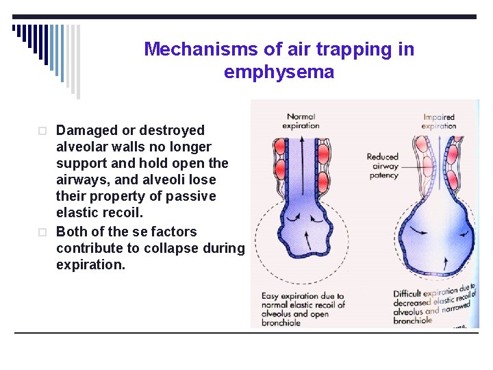 Mechanisms of air trapping in emphysema o Damaged or destroyed alveolar walls no longer