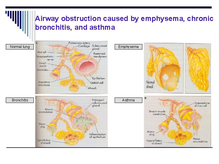 Airway obstruction caused by emphysema, chronic bronchitis, and asthma Normal lung Emphysema Bronchitis Asthma