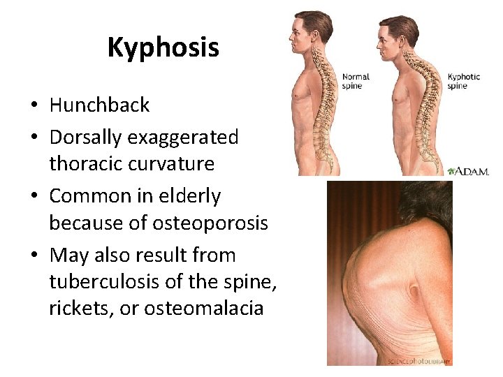 Kyphosis • Hunchback • Dorsally exaggerated thoracic curvature • Common in elderly because of
