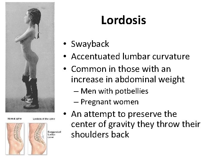 Lordosis • Swayback • Accentuated lumbar curvature • Common in those with an increase