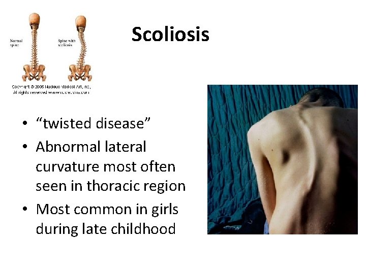 Scoliosis • “twisted disease” • Abnormal lateral curvature most often seen in thoracic region