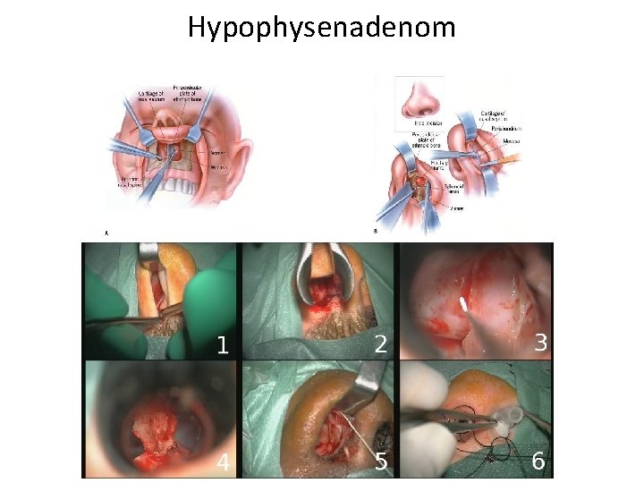 Hypophysenadenom 