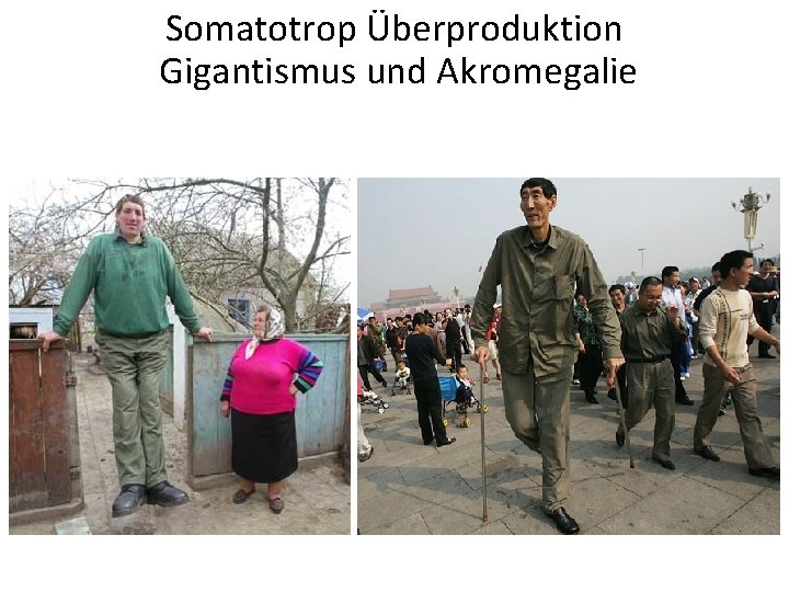 Somatotrop Überproduktion Gigantismus und Akromegalie 