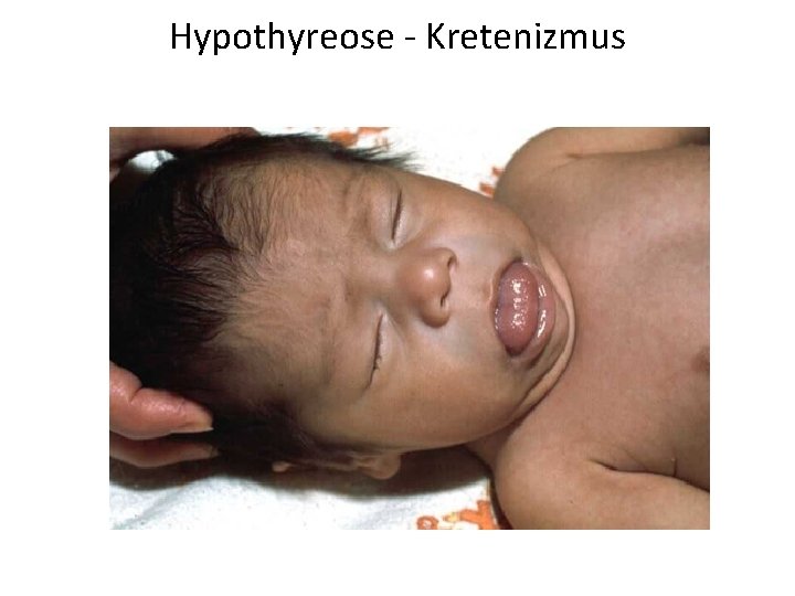 Hypothyreose - Kretenizmus 