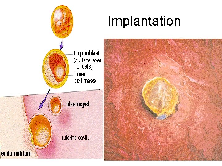 Implantation 