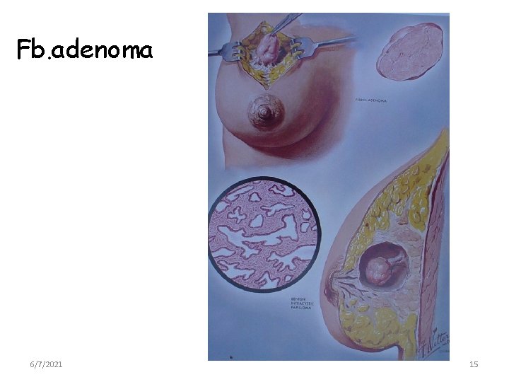 Fb. adenoma 6/7/2021 15 