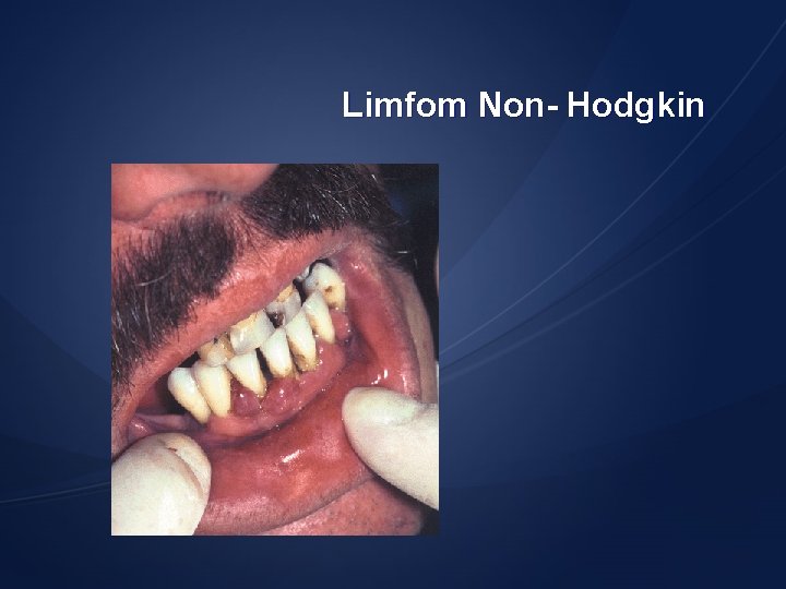 Limfom Non- Hodgkin 