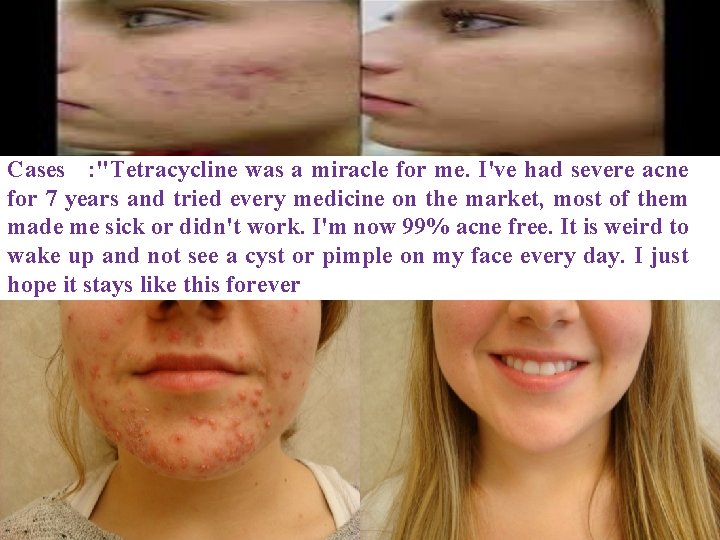 Cases : "Tetracycline was a miracle for me. I've had severe acne for 7 Cases : "Tetracycline was a miracle for me. I've had severe acne for 7