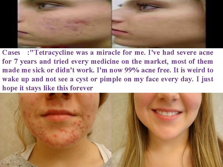 Cases : "Tetracycline was a miracle for me. I've had severe acne for 7