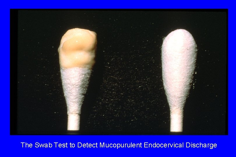 The Swab Test to Detect Mucopurulent Endocervical Discharge 