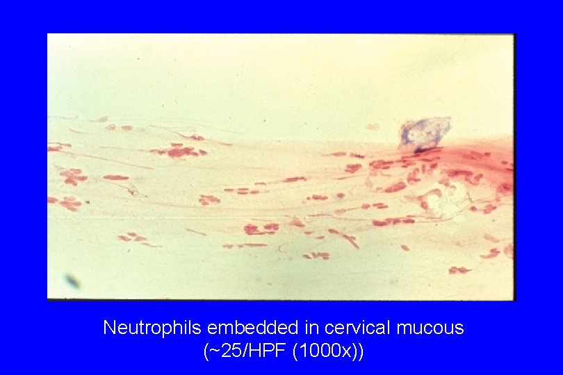 Neutrophils embedded in cervical mucous (~25/HPF (1000 x)) 